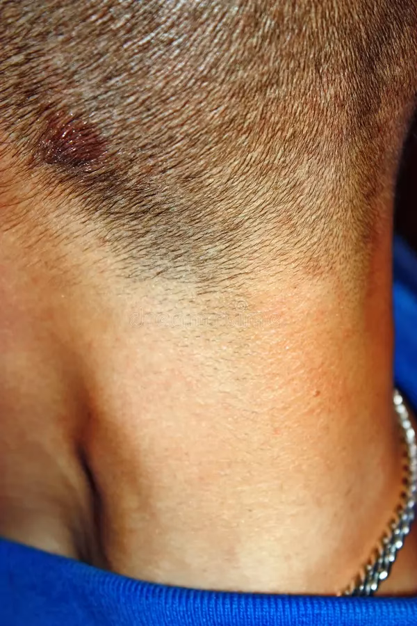 ¿Cómo se quita la sarna en la cabeza?