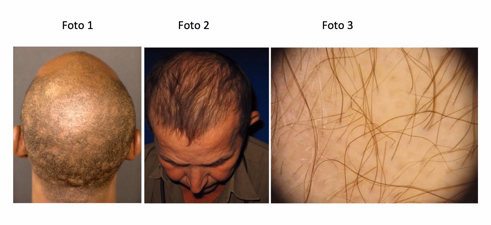 ¿Cómo es la caída de cabello por sífilis?
