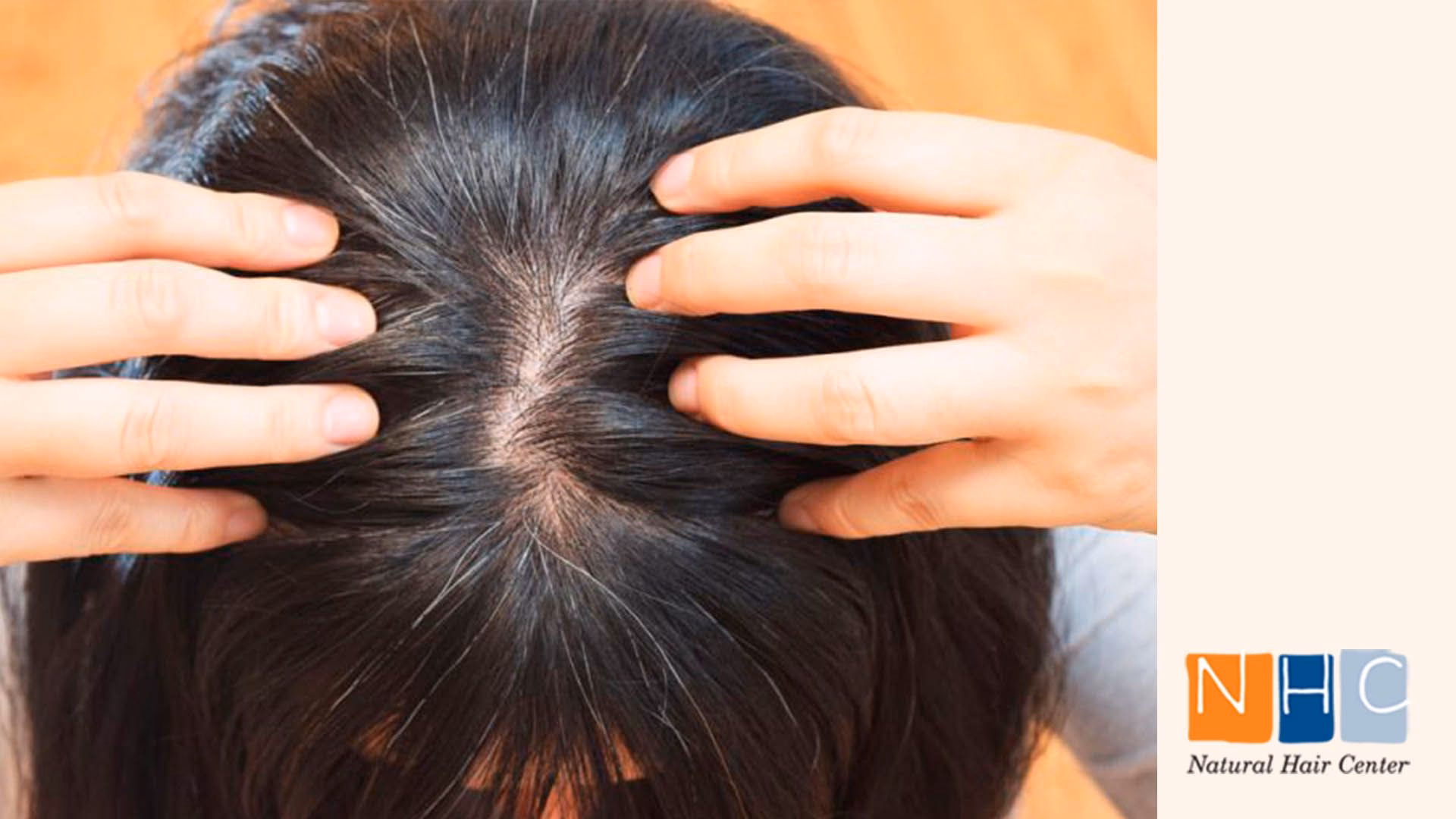 ¿En todas las quimios se cae el pelo?