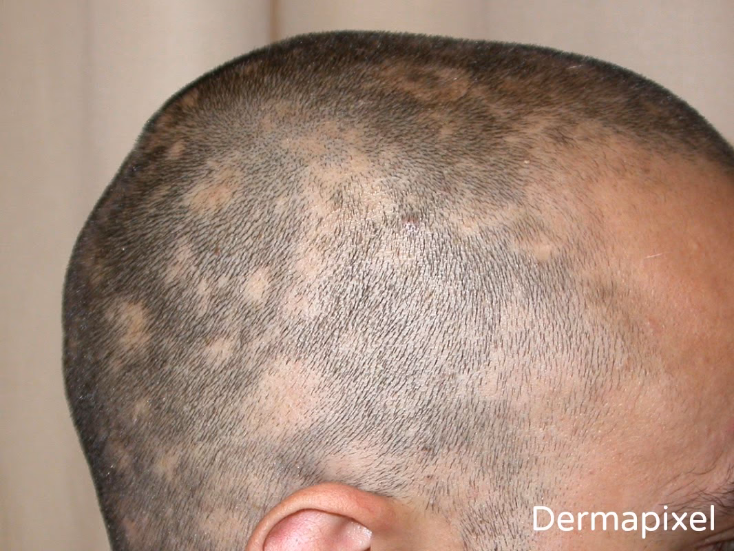 ¿Qué significa cuando te salen manchas en la cabeza?