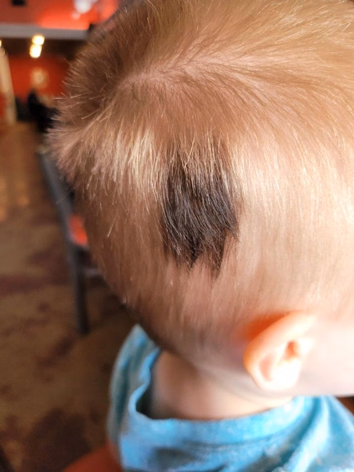 ¿Qué son los lunares de nacimiento con pelos?