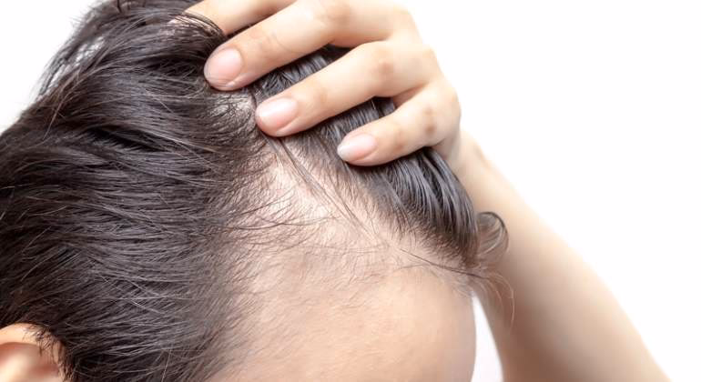 ¿Cómo puedo recuperar el cabello de las entradas?