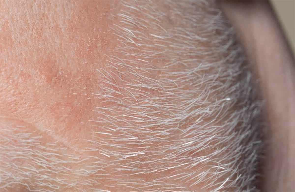 ¿Por qué me salen pelos blancos en la espalda?