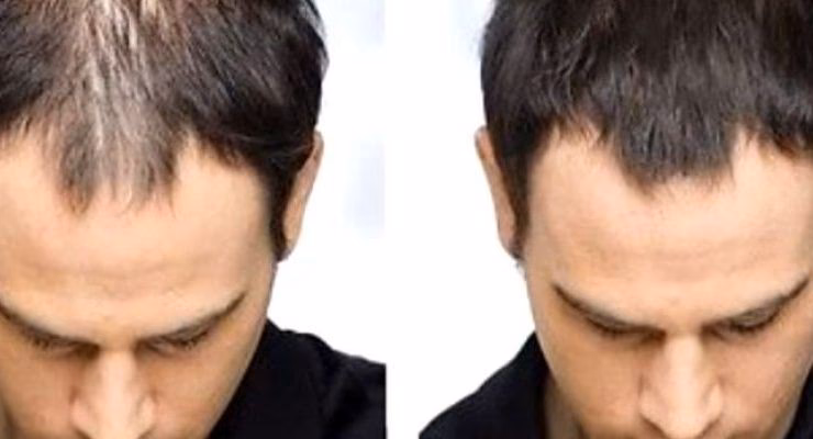 ¿Cuál es el reemplazo de cabello más efectivo?