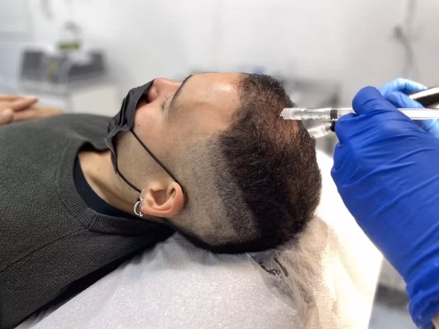 ¿Cuánto tiempo dura el efecto de la mesoterapia capilar?