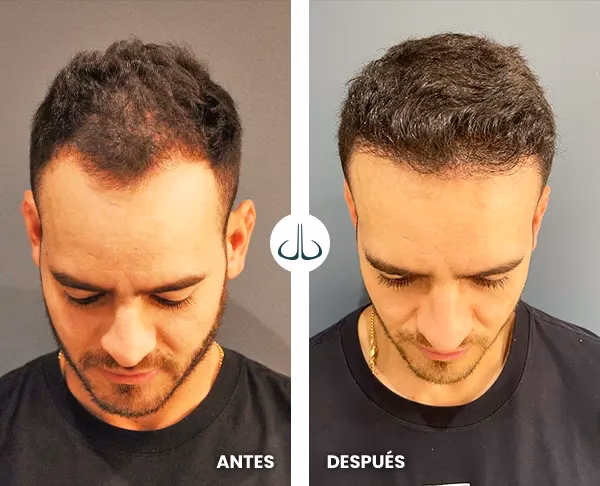 ¿Microimplante capilar técnica fue?