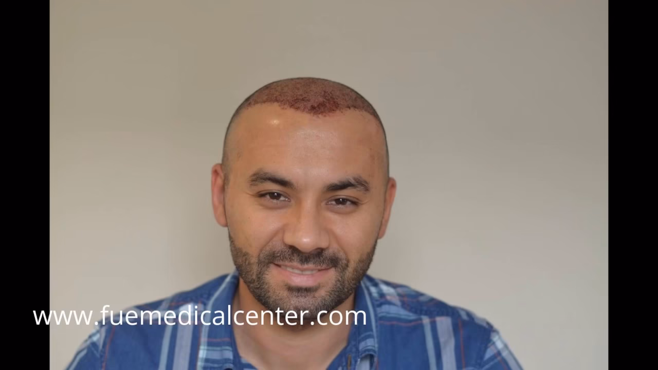 ¿Cuánto tarda en crecer el pelo después de un implante?