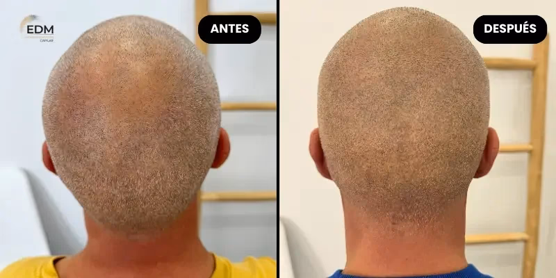 ¿Cuánto cuesta la micropigmentación capilar en Perú?