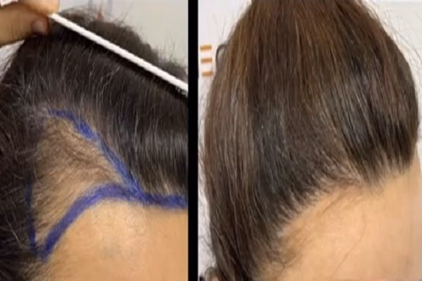¿Puedo hacerme un trasplante de cabello sin cortarme el pelo?