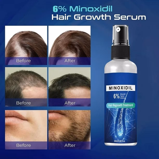 ¿Cómo se aplica el minoxidil en Sprite?