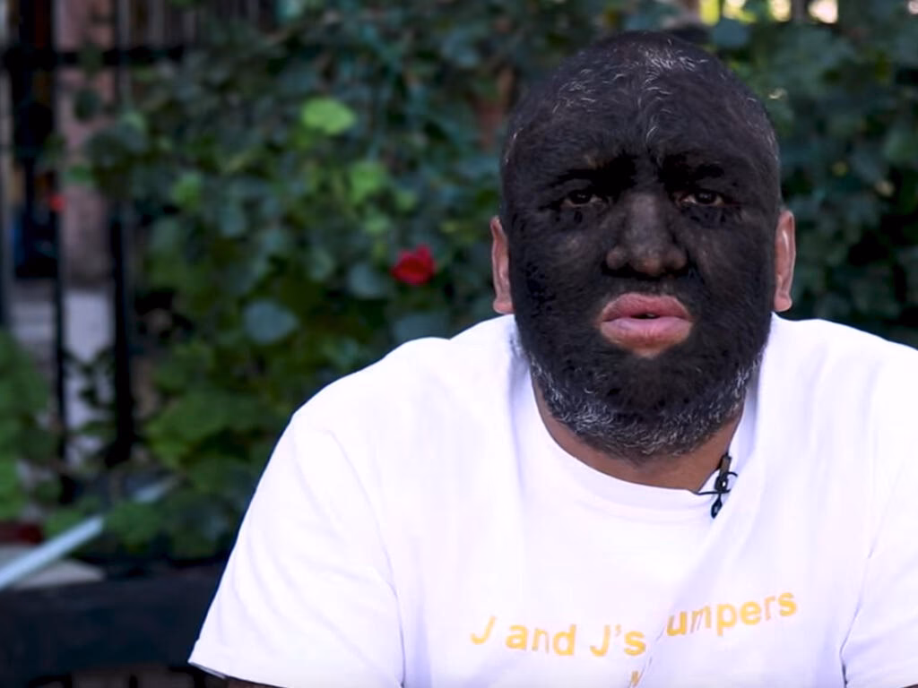 ¿Porque me sale mucho vello facial?