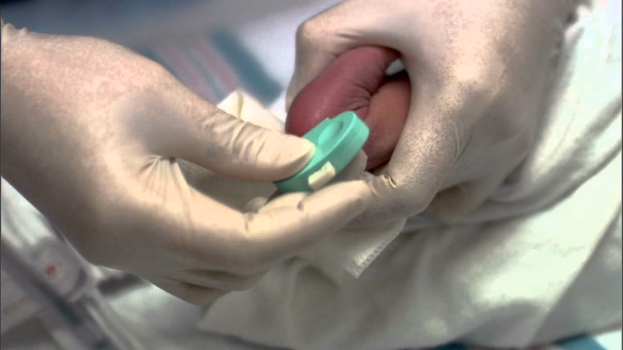 ¿Qué es una muestra de sangre capilar para bebés?