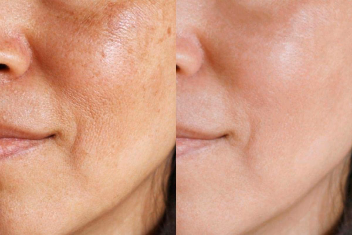 ¿Es buena el agua oxigenada para eliminar las manchas de la cara?