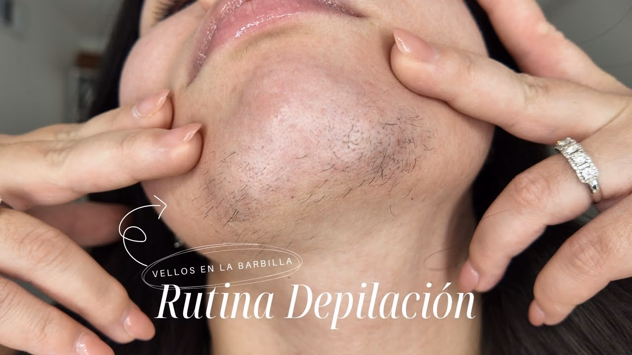 ¿Cómo eliminar el hirsutismo en mujeres?