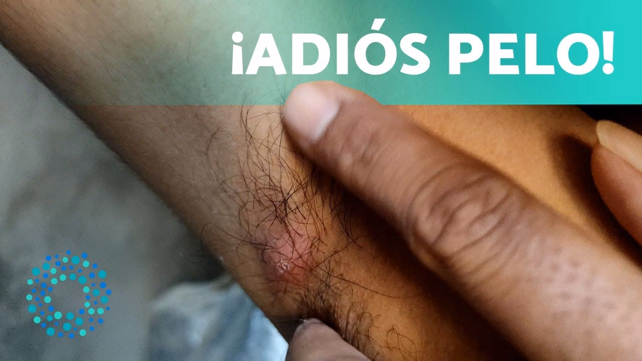 ¿Cómo quitar el dolor de un pelo encarnado?