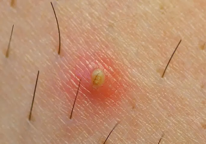 ¿Cómo puedo eliminar el vello encarnado en la zona intima?