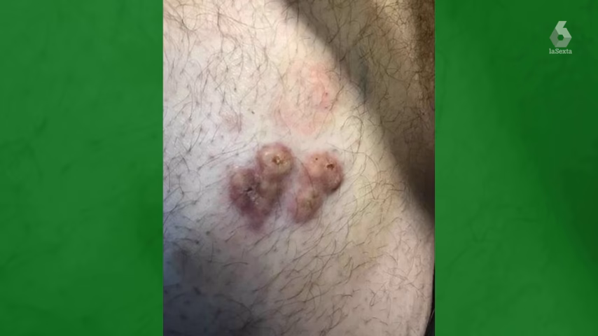 ¿Cuánto tarda en irse un pelo enquistado?