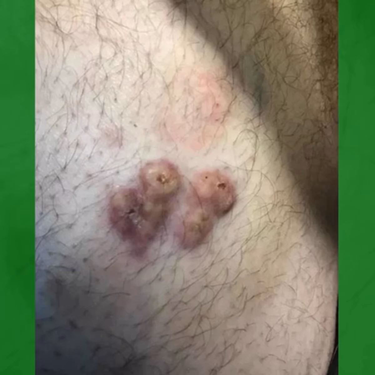 ¿Cómo curar un pelo encarnado en la ingle?