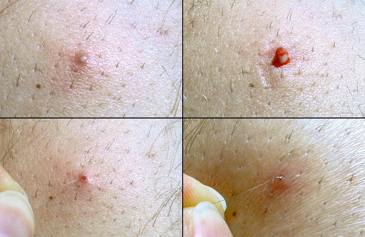 ¿Cómo quitar un grano enquistado en el pubis?