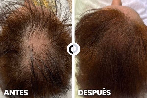 ¿Cuánto tarda en crecer el cabello si tengo alopecia areata?