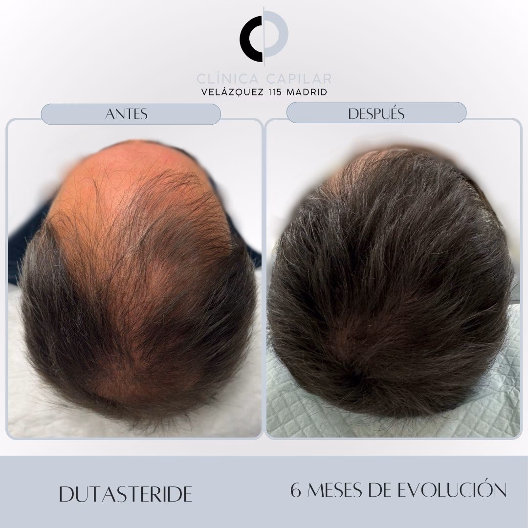 ¿Cuántos años dura la alopecia areata?