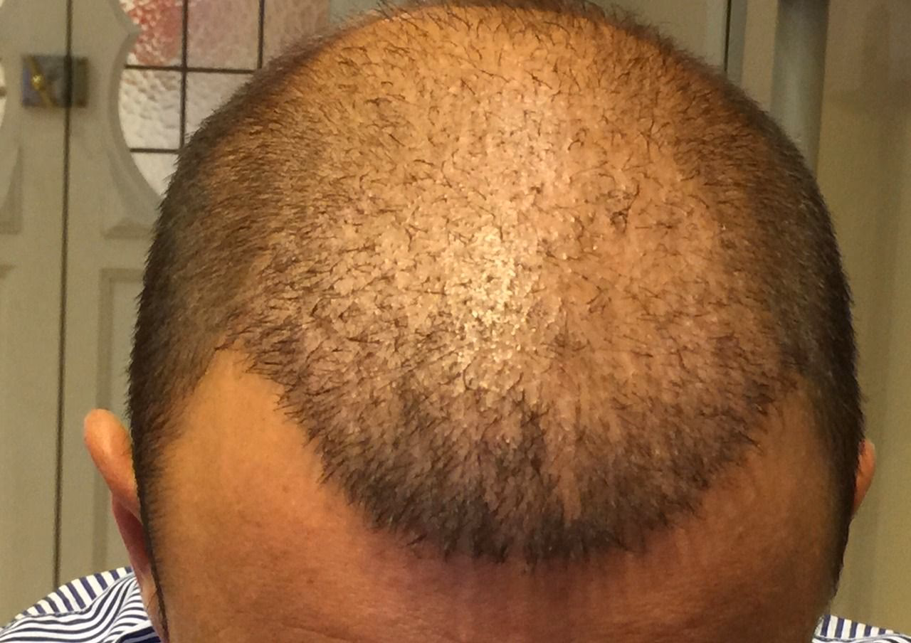 ¿El pelo implantado vuelve a crecer?