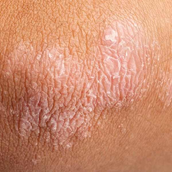 ¿Qué significa picazón en el escroto?