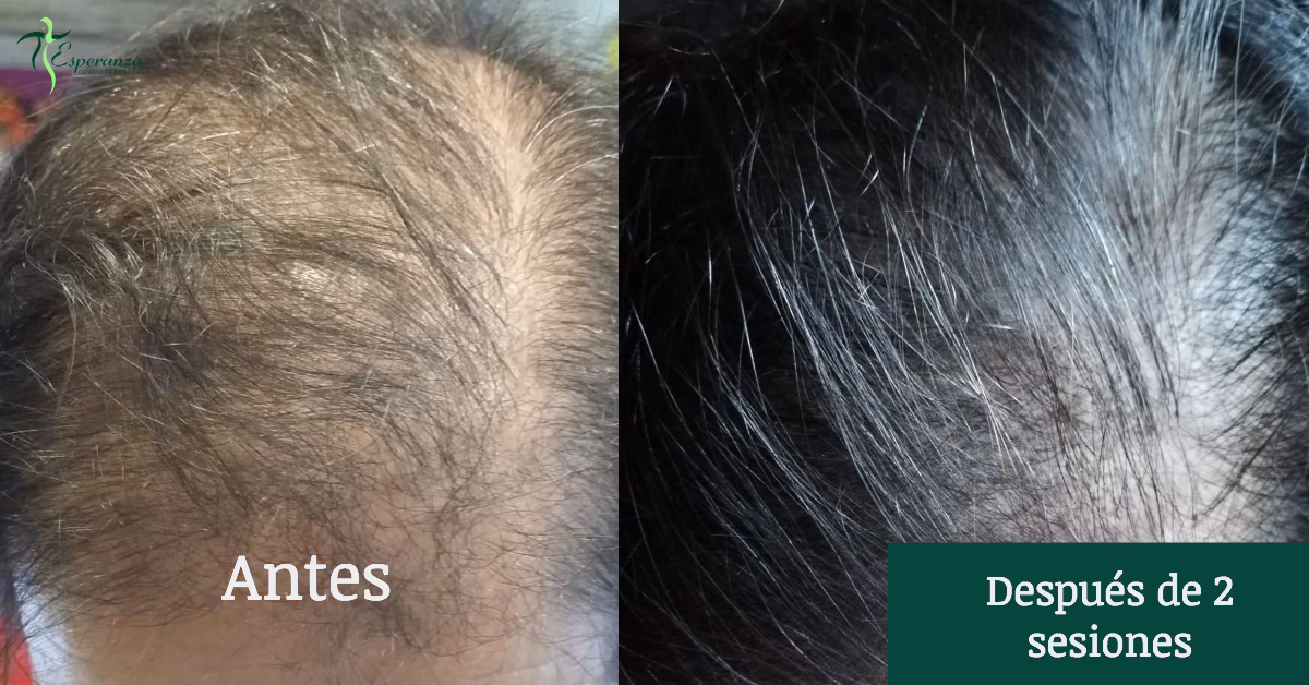 ¿Qué efectos tiene el plasma en el cuero cabelludo?
