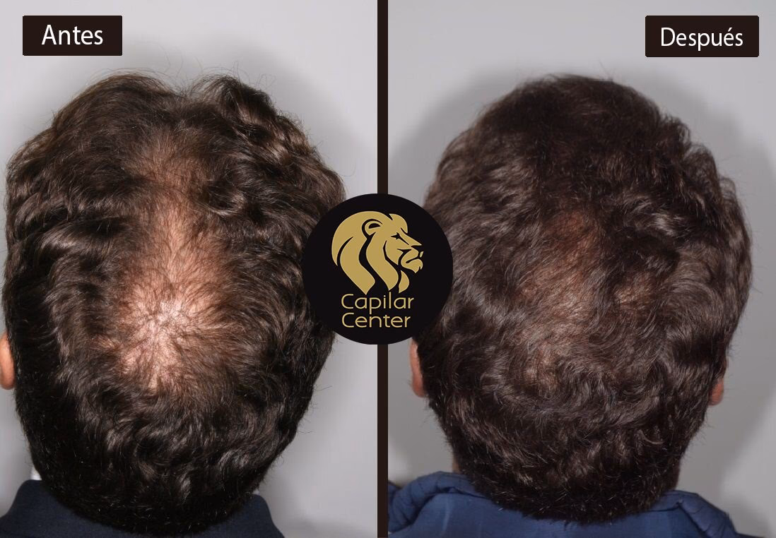 ¿Cuántas sesiones de plasma se necesitan para el cabello?