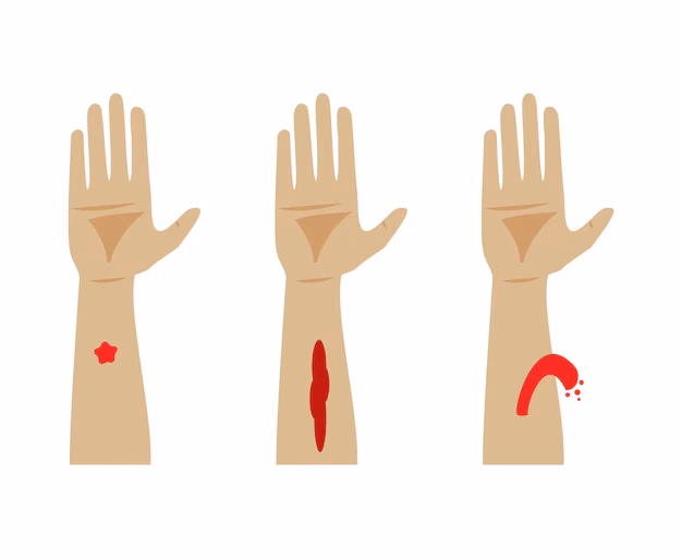 ¿Cómo contener una hemorragia capilar?