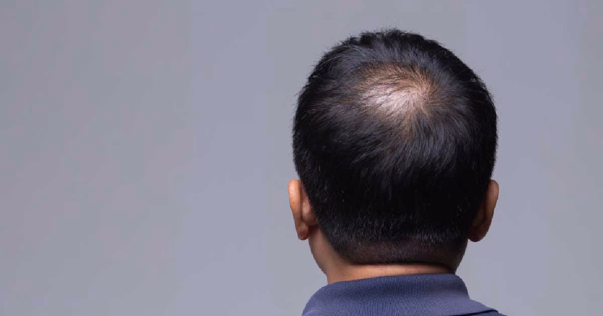 ¿Por qué pierdo pelo en la coronilla?