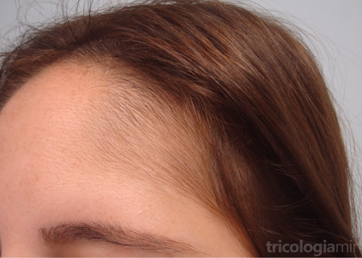 ¿Qué pasa si me quito los pelitos de la cara?