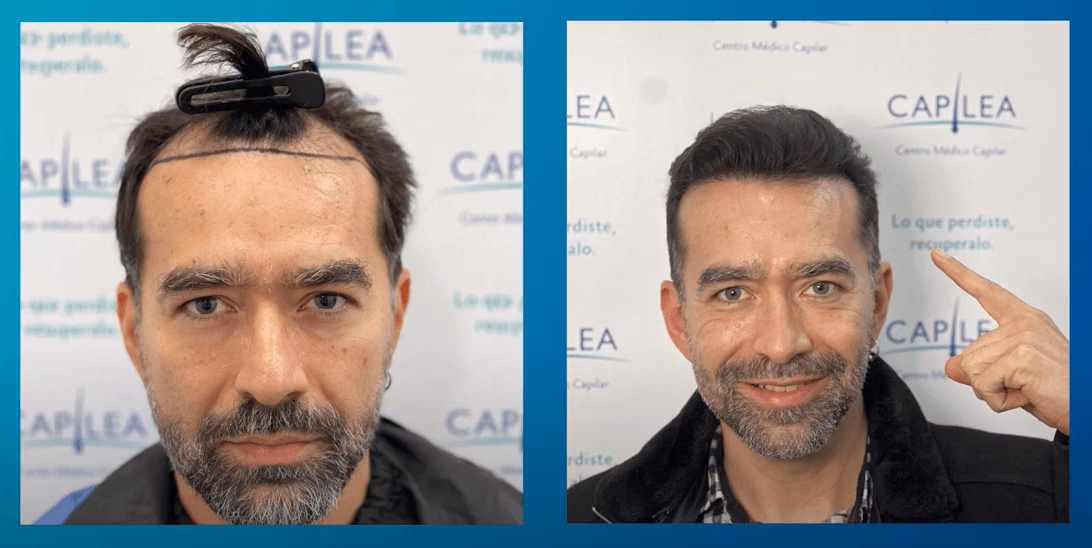 ¿Cuánto cubren 5000 injertos?