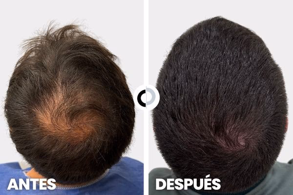 ¿Cómo hacer solución de finasterida?