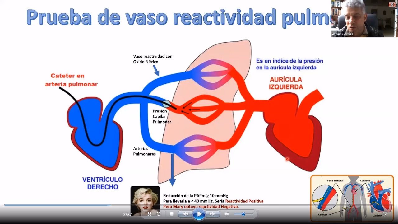 ¿Qué es la presión de enclavamiento capilar pulmonar?