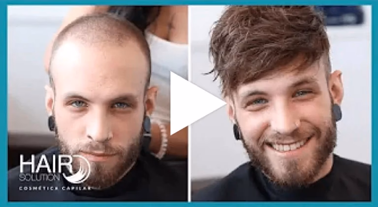 ¿Cuánto dura una prótesis capilar indetectable?