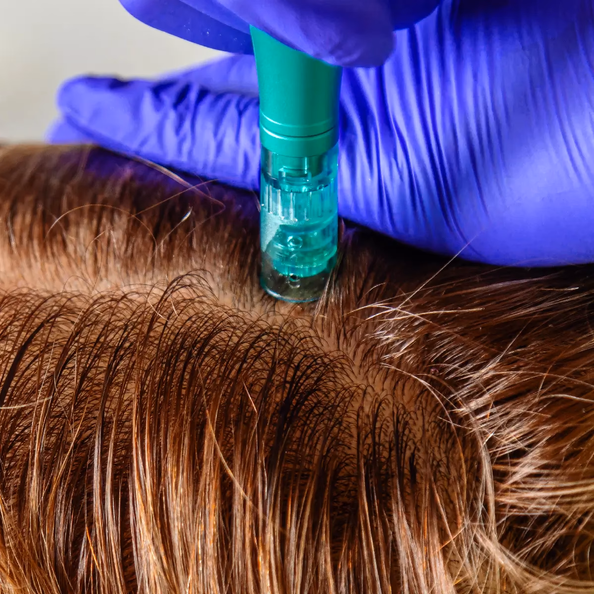 ¿Cómo aplicar plasma rico en plaquetas paso a paso?