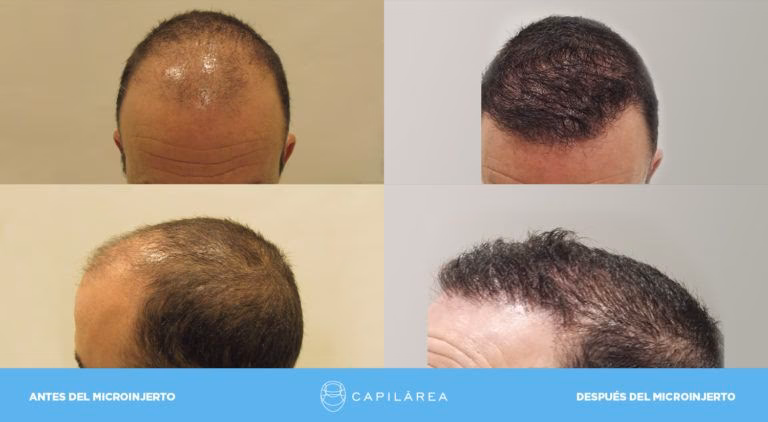 ¿Cuándo puedo hacerme un PRP después del trasplante capilar?