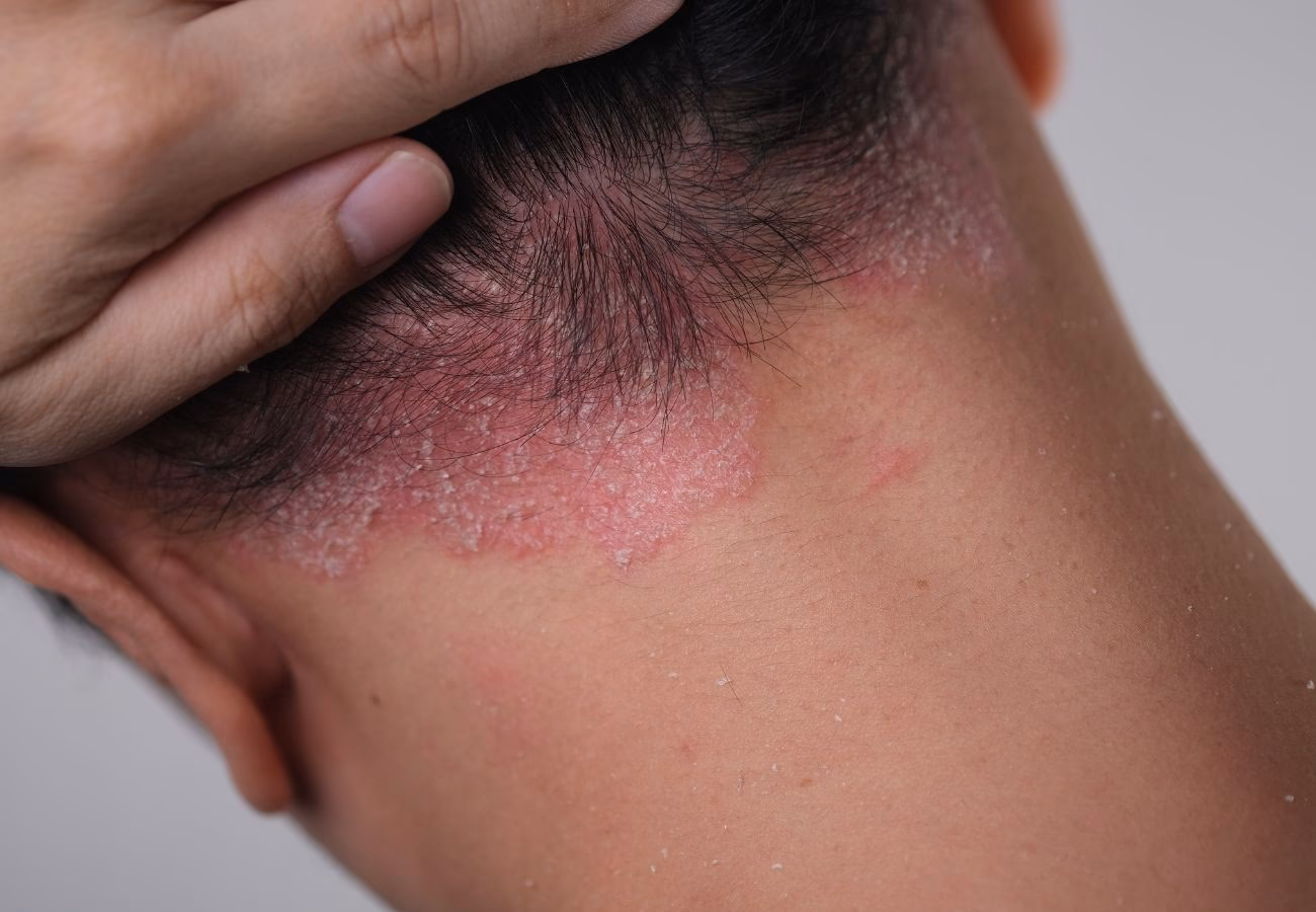 ¿Cómo evitar la caída del cabello por psoriasis?