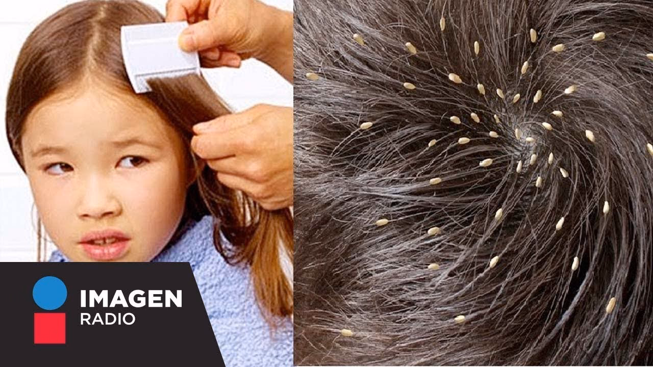 ¿Qué tipo de pelo atrae a los piojos?