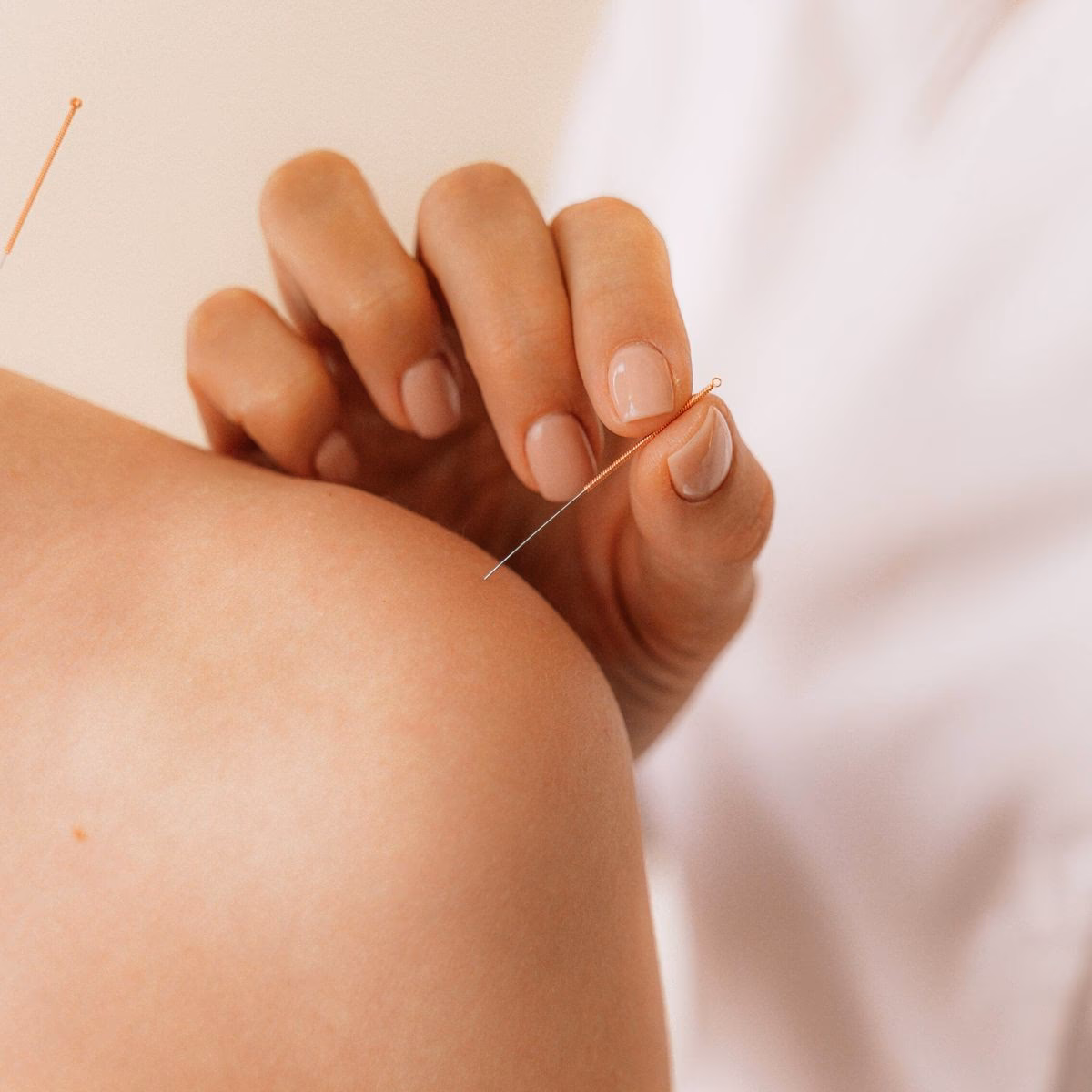 ¿Puede la acupuntura ayudar al crecimiento del cabello?