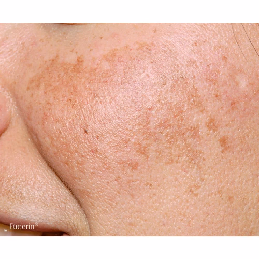 ¿Qué es lo que provoca la pigmentación de la piel?