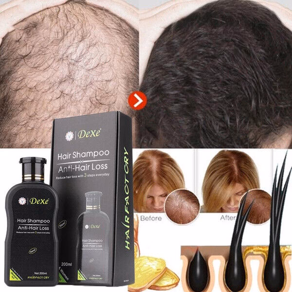 ¿Qué champú es bueno para la caída del cabello y crezca rápido?