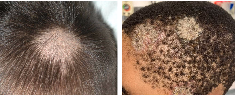 ¿Cómo es la caída por quiebre?