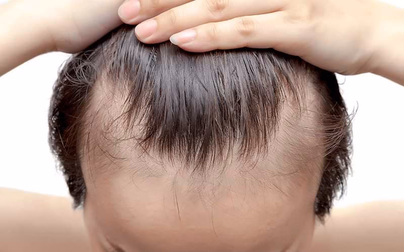 ¿Cómo saber si tengo seborrea en el cabello?