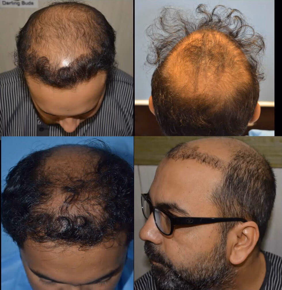 ¿Qué pasa si un trasplante de cabello falla?