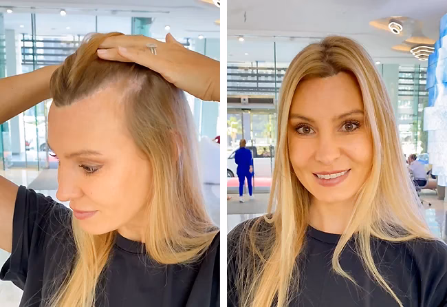 ¿El trasplante de cabello es una buena opción?