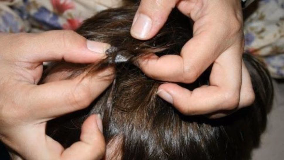 ¿Cómo quitar chicle del cabello con alcohol?