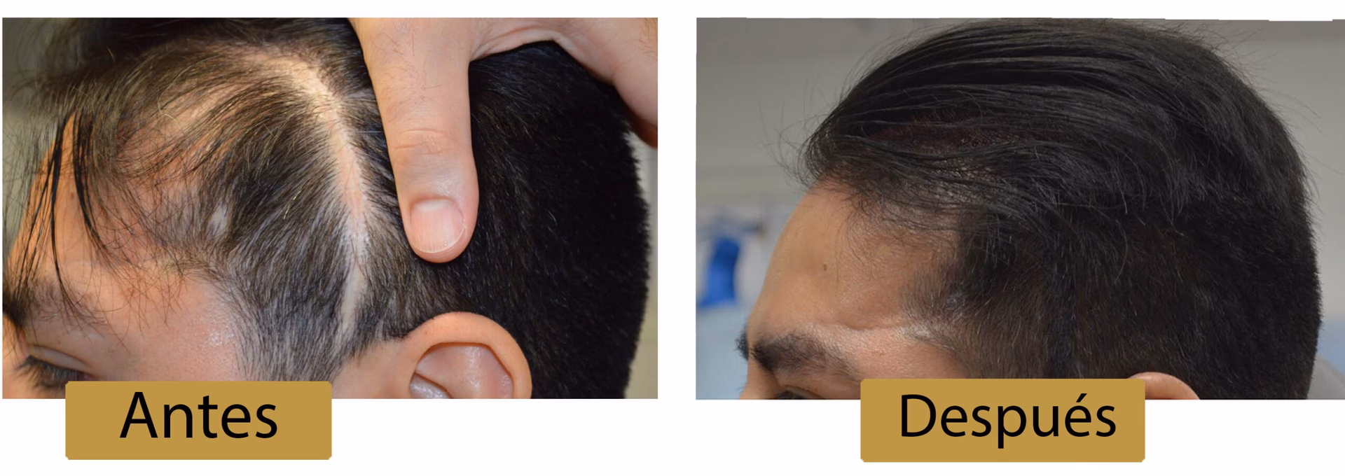 ¿Cómo hacer crecer pelo en una cicatriz?