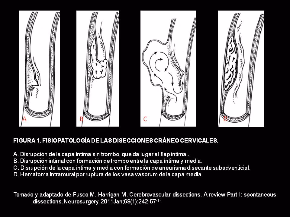 ¿Cómo afecta la presión alta en los ojos?